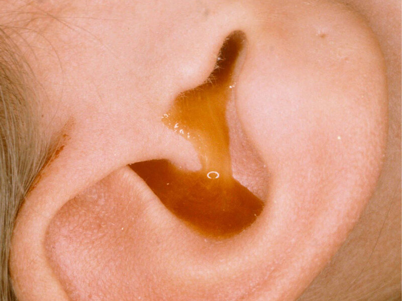 Khi bị nhiễm trùng tai, tai của bé có thể bị chảy dịch lỏng màu trắng hoặc vàng