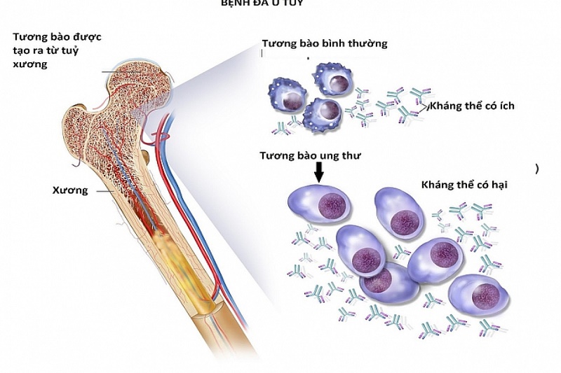 Đa u tủy là một dạng ung thư máu ác tính, với đặc trưng là sự tăng sinh của tương bào ở tủy xương và các cơ quan khác