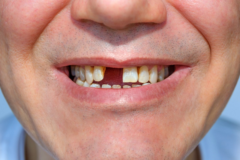 Trồng răng Implant có thể áp dụng trong hầu hết các trường hợp mất răng, chỉ cần bạn có một sức khỏe tốt