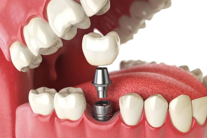 Việc lựa chọn loại trụ Implant phù hợp sẽ giúp bạn hồi phục hình răng nhanh chóng, giảm thời gian chờ đợi tích hợp giữa xương hàm và trụ
