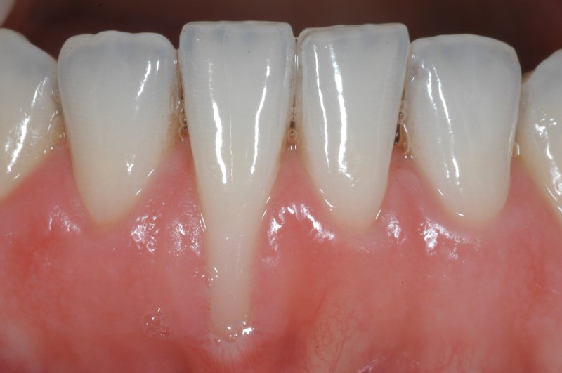 Tụt nướu bệnh lý răng miệng xảy ra phổ biến ở mọi người
