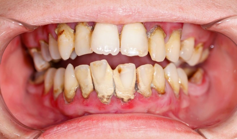 Cao răng bám quá nhiều có thể khiến lợi bị tụt