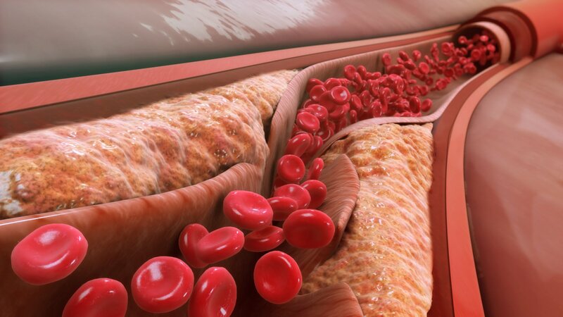  Cholesterol máu cao dễ dẫn đến xơ vữa động mạch