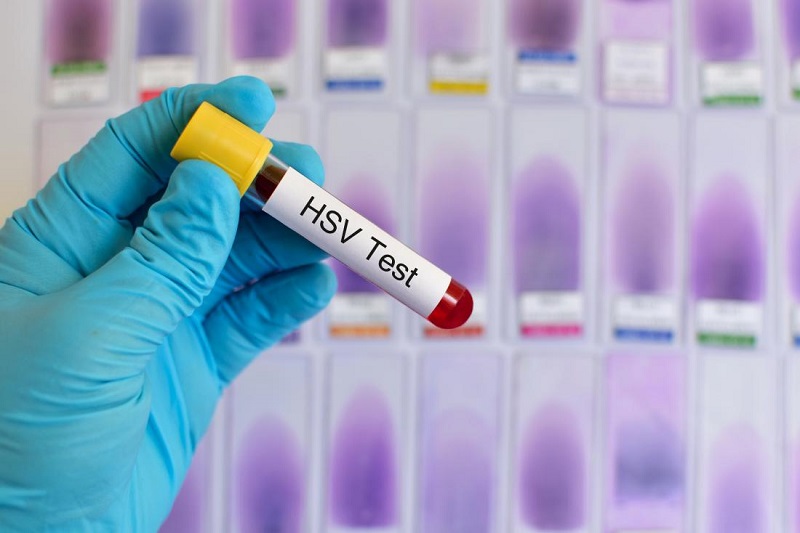 Xét nghiệm cấy HSV giúp tìm virus gây bệnh herpes