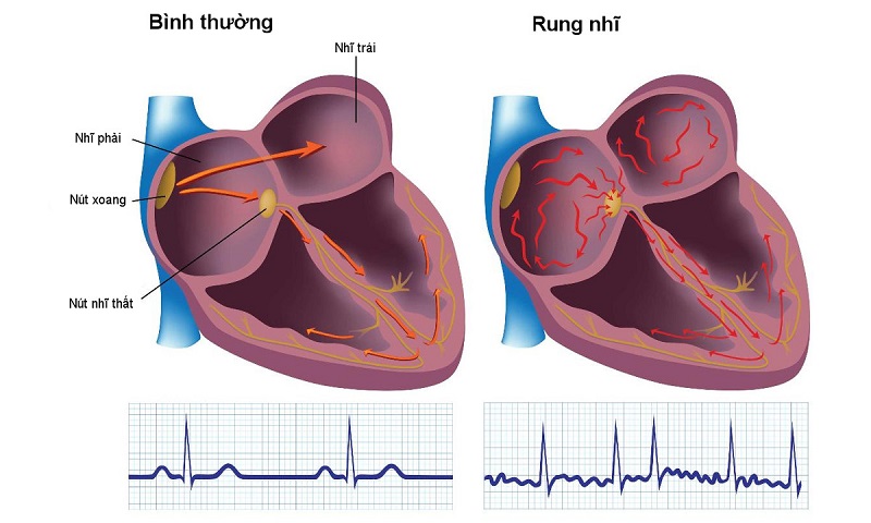 Bệnh rung nhĩ khiến cho nhịp tim bị rối loạn theo hướng tăng bất thường