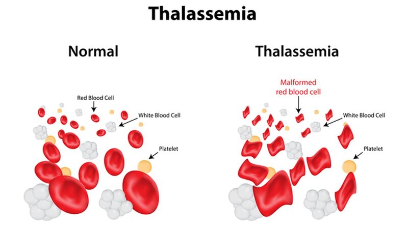 Bệnh Thalassemia là bệnh di truyền do bất thường về gen