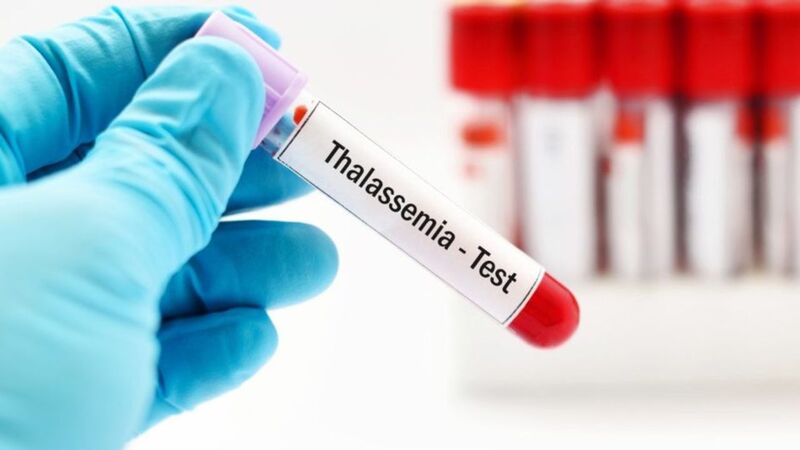 Bệnh Thalassemia nặng có thể khiến trẻ tử vong sớm do biến chứng thiếu máu nặng