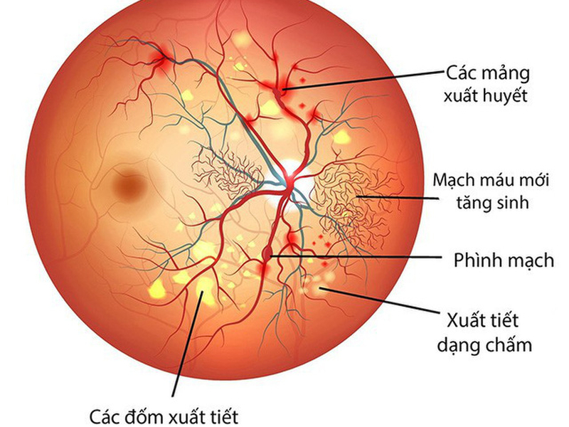 Đái tháo đường ảnh hưởng đến mạch máu võng mạc gây giảm thị lực