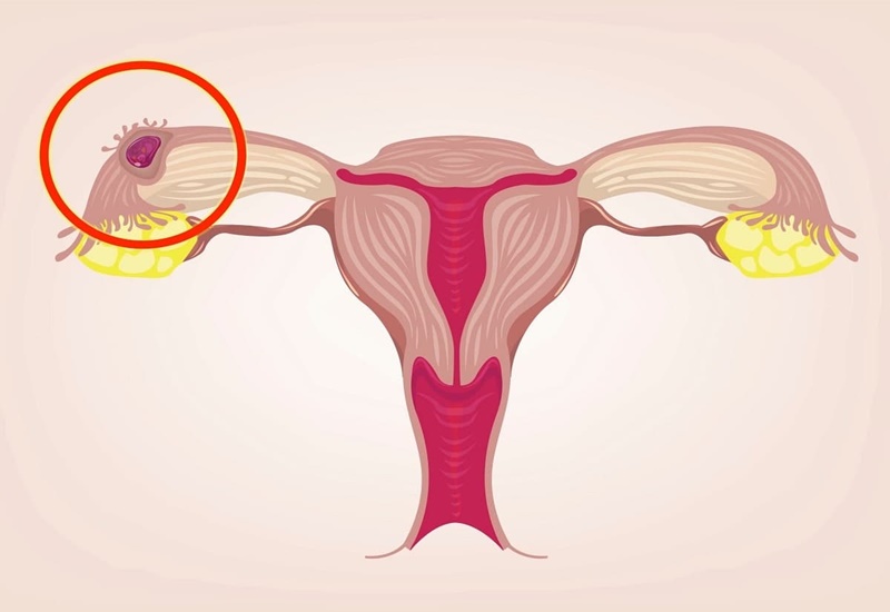 Mang thai ngoài tử cung gây ra tình trạng khí hư có màu nâu