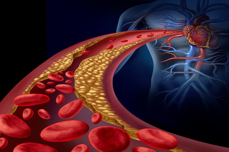 Bệnh xảy ra khi hàm lượng Cholesterol toàn phần, Triglycerid tăng bất thường, cùng với sự suy giảm của HDL - Cholesterol tốt