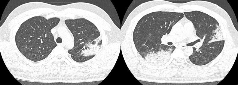 Hình ảnh tổn thương đông đặc nhu mô hai phổi chủ yếu vùng ngoại vi