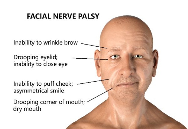 Liệt dây thần kinh số 7 hay còn gọi là liệt mặt có thể gặp ở hầu hết mọi đối tượng