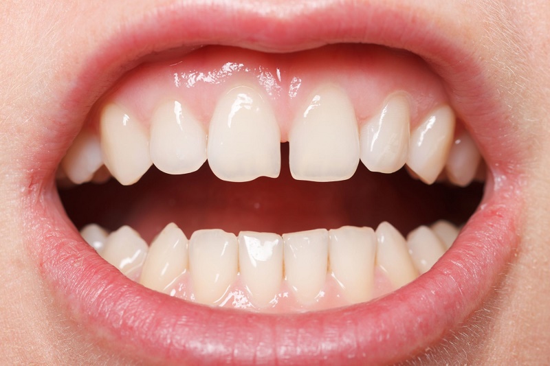 Những người đang gặp phải tình trạng: răng hô, thưa, lệch lạc,… đều có thể khắc phục bằng phương pháp niềng răng mắc cài trong suốt