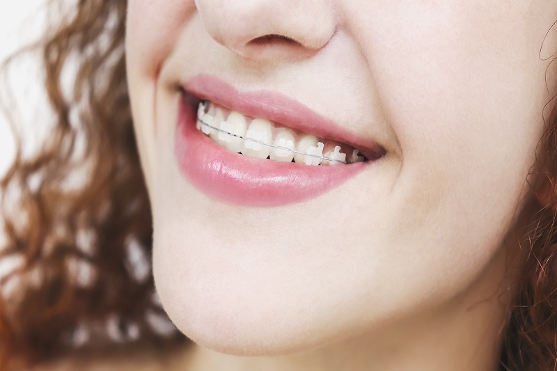 Với thiết kế mắc cài cùng màu răng nên khi nhìn vào, người ngoài khó phát hiện được bạn đang thực hiện chỉnh nha