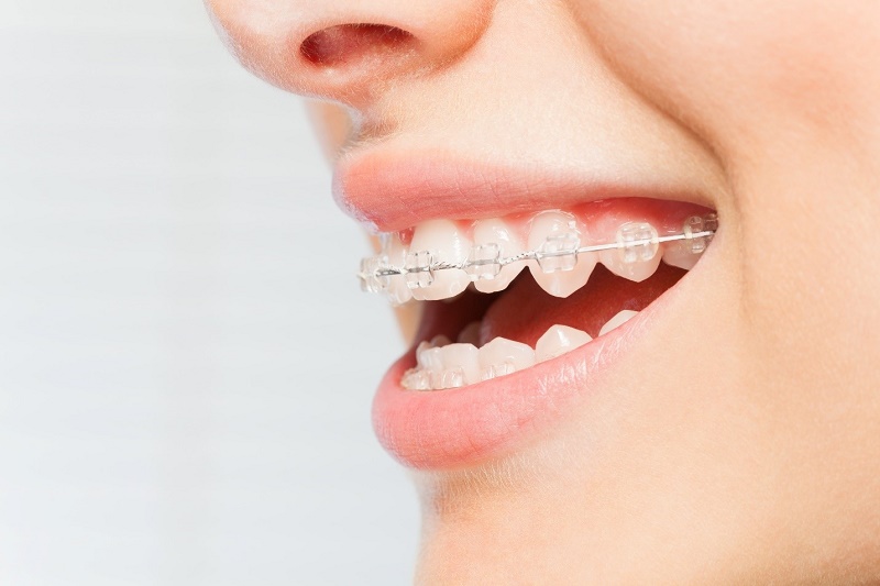 Mắc cài làm bằng sứ hoặc pha lê có kích thước lớn khiến bạn có cảm giác bị cộm và môi bị nhô ra khi mới niềng răng