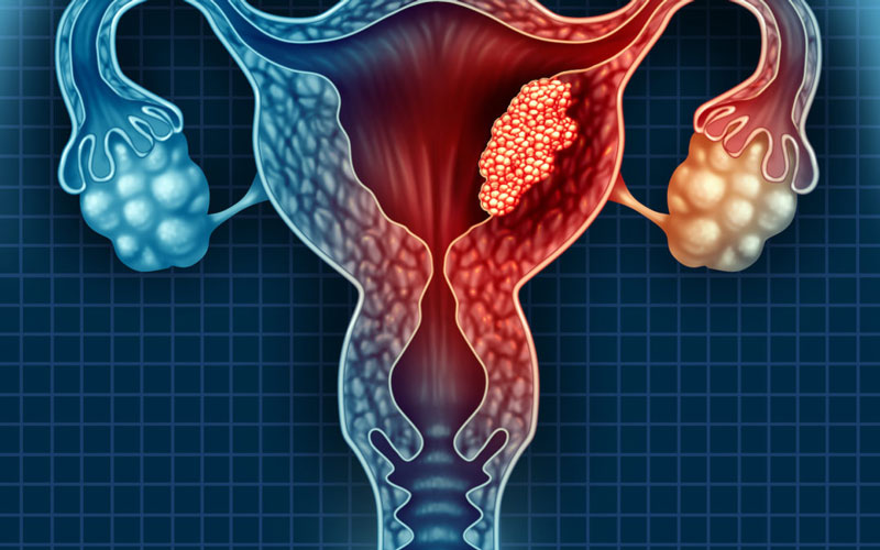 Ung thư cổ tử cung là vấn đề thường gặp ở phụ nữ