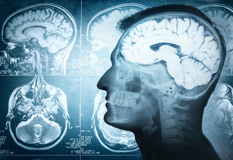 Hội chứng màng não là một tình trạng tổn thương não rất nguy hiểm