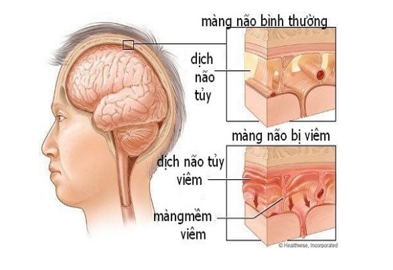 Dịch não tủy thay đổi do hội chứng màng não