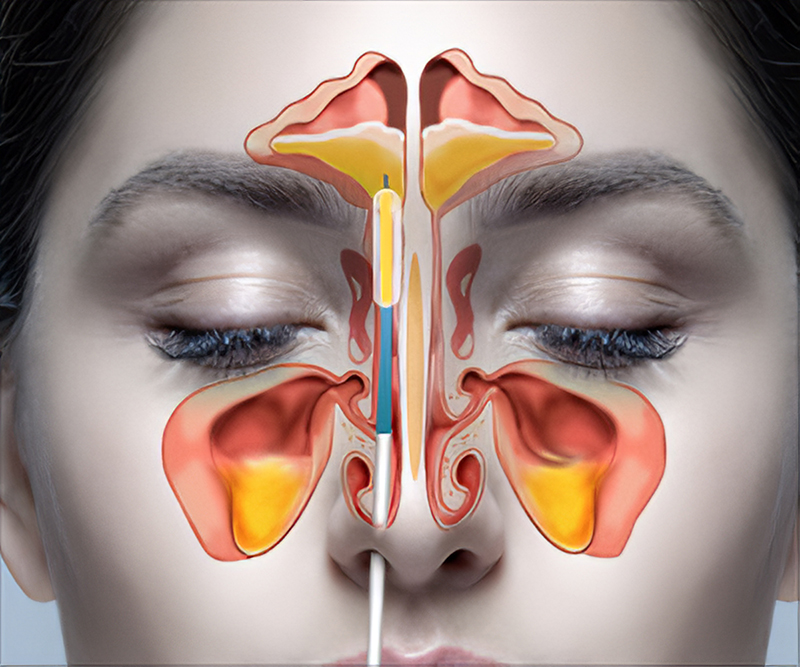 Viêm xoang mũi có thể xuất phát từ rất nhiều nguyên nhân khác nhau