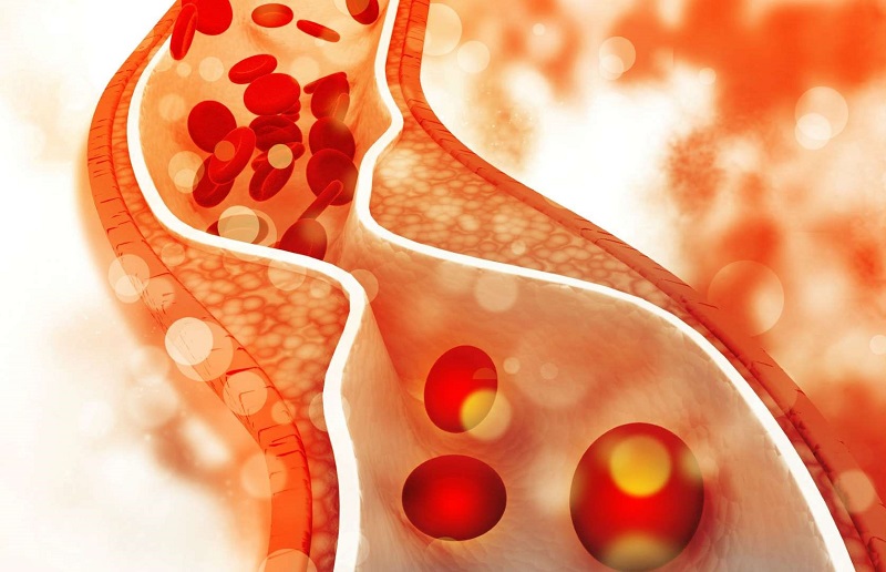 Xơ vữa động mạch máu với người có nồng độ cholesterol vượt mức an toàn