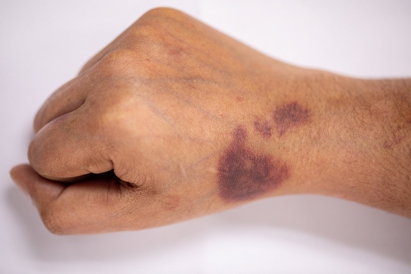 Người mắc bệnh máu khó đông thường xuất hiện những vết bầm tím trên cơ thể