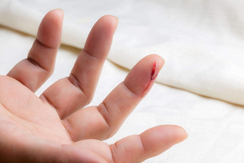 Những người có mức độ chảy máu nhẹ và không kéo dài thì nên có biện pháp can thiệp khi bị đứt tay như: băng ép, chườm đá,…
