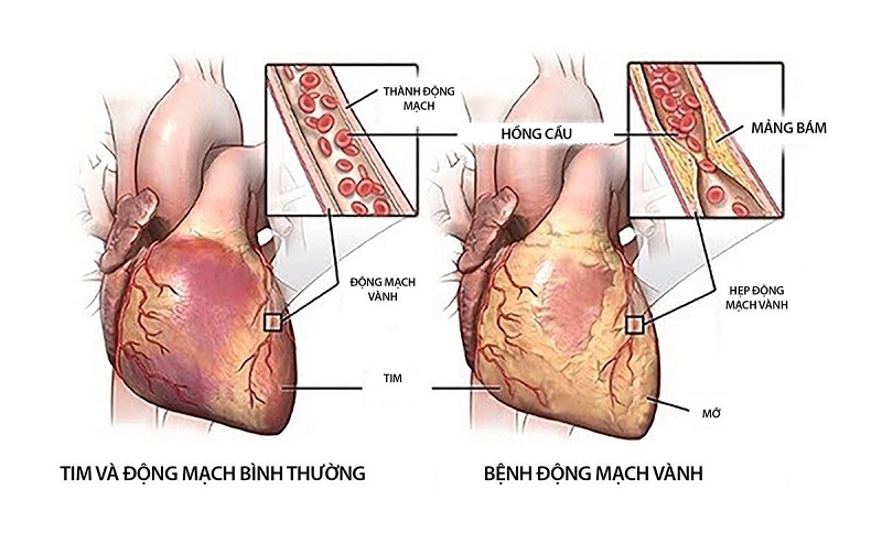 Bệnh động mạch vành là nguyên nhân gây thiếu dưỡng khí và hoại tử cơ tim