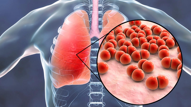 Nhiễm nấm Histoplasma có thể gây suy hô hấp nặng khi phổi bị tổn thương nghiêm trọng