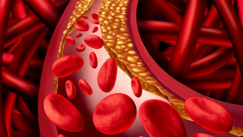  Mỡ máu cao xảy ra khi các chỉ số mỡ máu vượt ngưỡng an toàn trong cơ thể