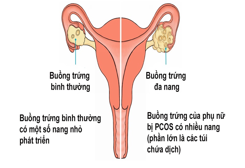Hội chứng buồng trứng đa nang gây ra nhiều triệu chứng khác nhau ở nữ giới