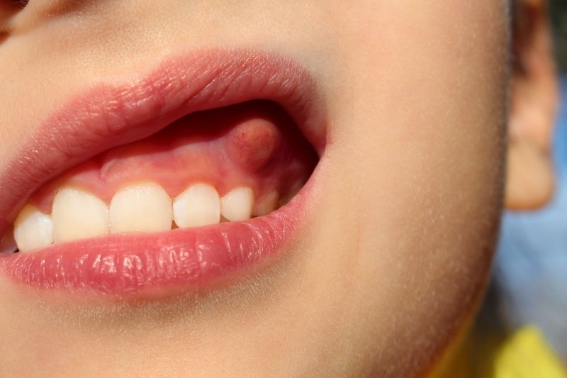 Áp xe răng là tình trạng nhiễm trùng, tích tụ mủ xảy ra ở chân răng