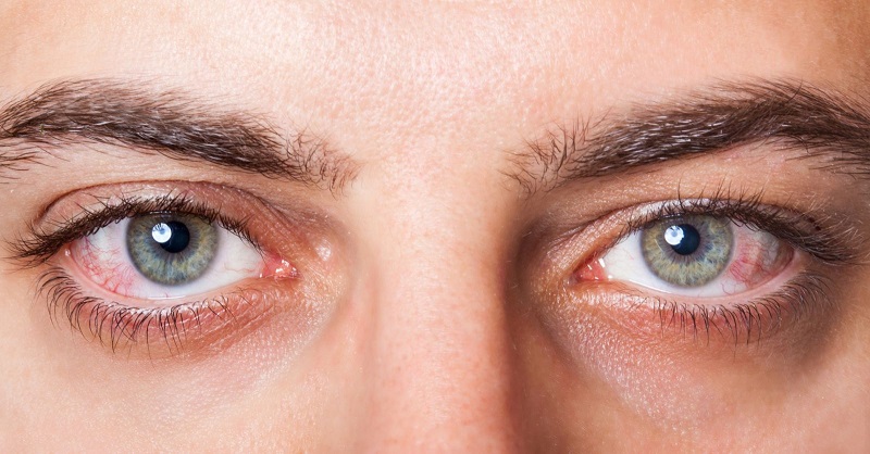 Viêm kết mạc gây đỏ, sưng và ngứa ở một hoặc cả hai bên mắt