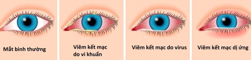 Biểu hiện viêm kết mạc mắt theo tác nhân gây bệnh