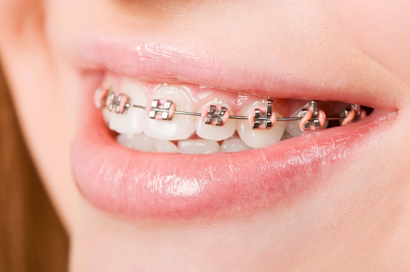 Niềng răng là giải pháp cải thiện khớp cắn ngược phù hợp với nhiều đối tượng