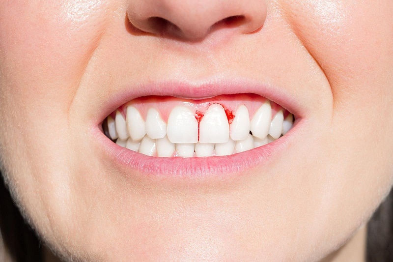 Cạo cao răng có thể gây tổn thương nướu và chảy máu nếu thao tác thực hiện của nha sĩ không chính xác