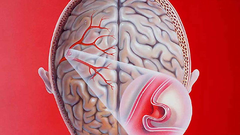 Phình mạch não là gì?