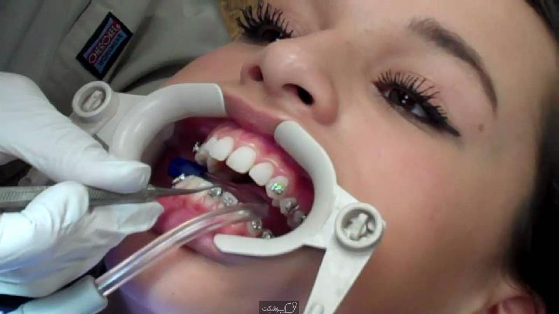 Tình trạng ê buốt, đau nhức có thể sẽ diễn ra từ 3 đến 5 ngày sau khi niềng răng