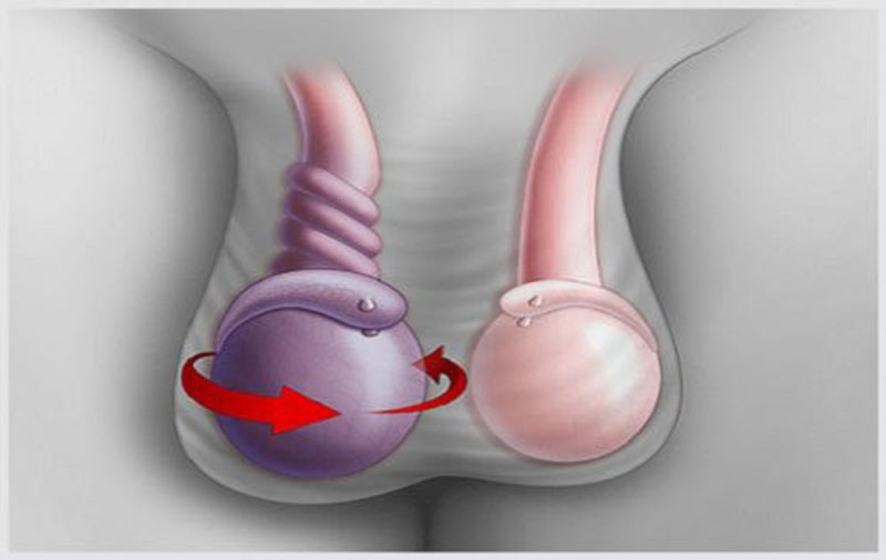 Xoắn tinh hoàn gây đau nhức một bên ở vùng bụng dưới và khu vực tinh hoàn