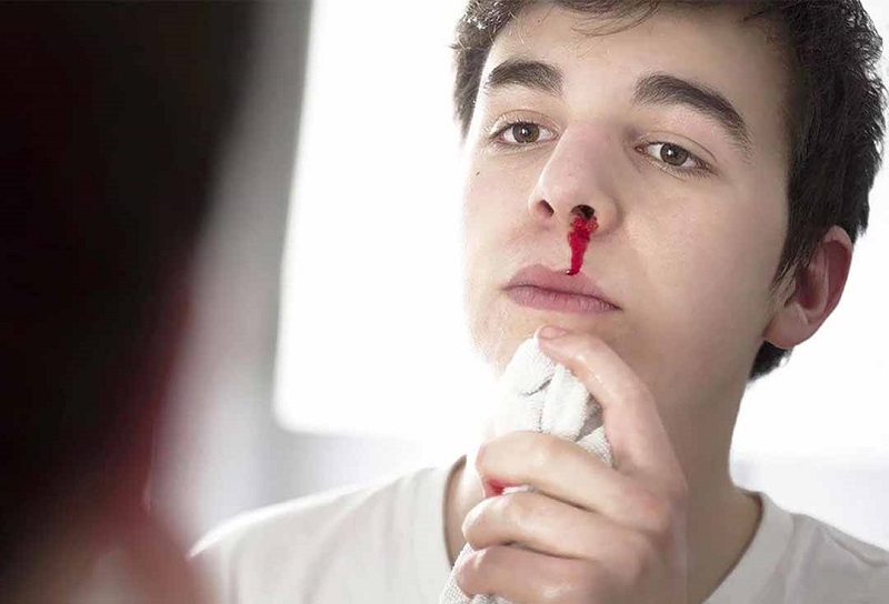 Tùy vào giai đoạn của bệnh mà người bị ung thư xoang mặt sẽ có triệu chứng chảy máu mũi ở mức độ khác nhau