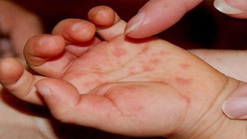 Người bị nhiễm Enterovirus dễ có các nốt ban đỏ trên da