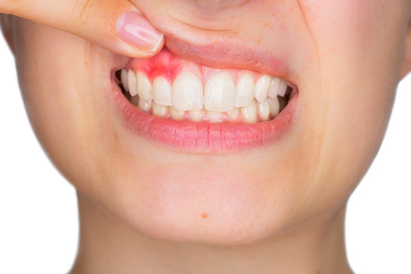 Nướu răng bị đỏ là một dấu hiệu cảnh báo sức khỏe vô cùng nguy hiểm