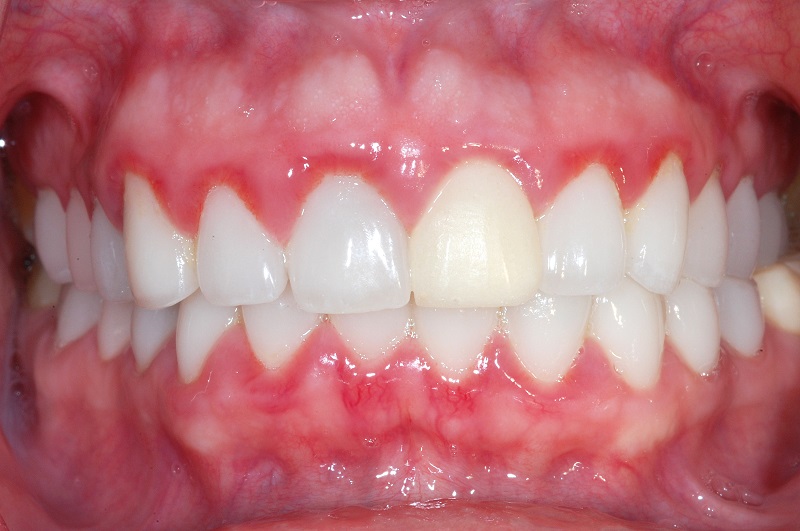 Bệnh viêm nướu răng có triệu chứng là nướu răng bị sưng đỏ