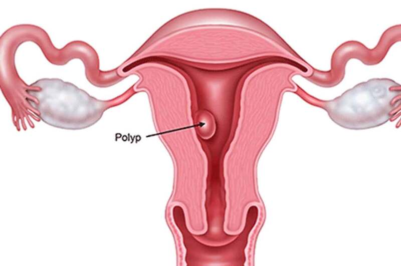  Polyp nội mạc tử cung là dạng u lành tính