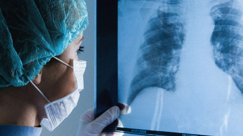 Chứng tim phổi mạn xảy ra vì nhiều nguyên nhân khác nhau