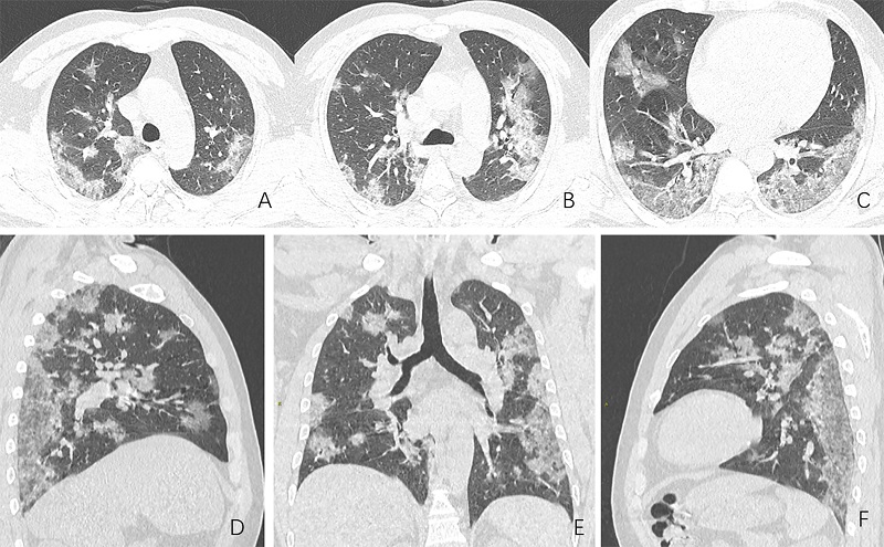 Lựa chọn địa chỉ uy tín chụp CT phổi hậu Covid để có kết quả đánh giá chính xác