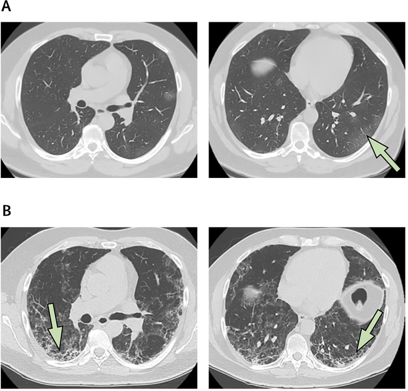 Xơ phổi hậu Covid-19, bệnh lý về phổi đáng lo ngại