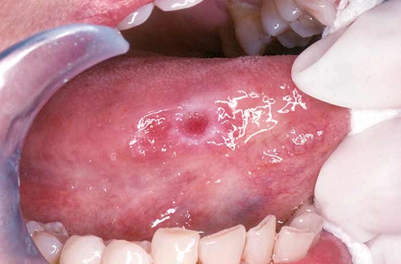 Triệu chứng loét miệng do ung thư khoang miệng dễ nhầm lẫn với bệnh nhiệt miệng thông thường