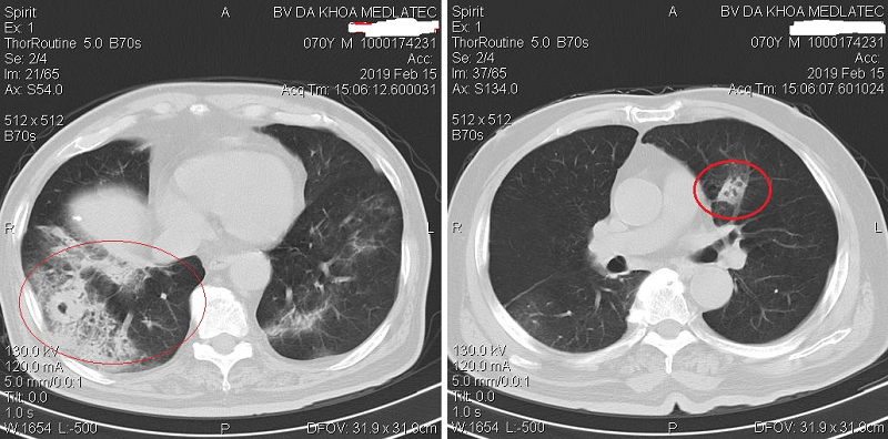 Chụp CT phổi có phát hiện hậu Covid không? 