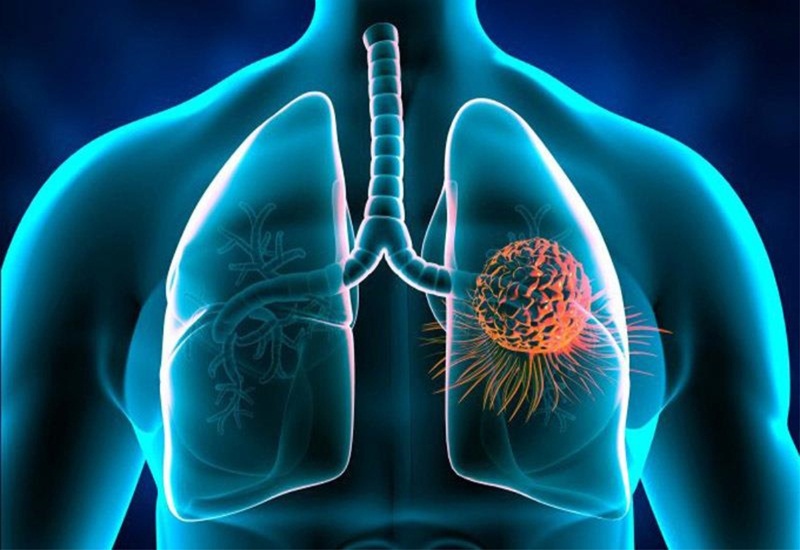 Càng đến những giai đoạn sau thì bệnh ung thư phổi càng trở nên nguy hiểm