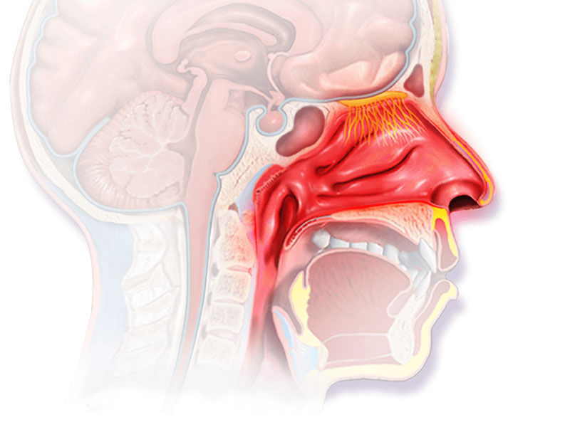 Viêm mũi dị ứng không chu kỳ kéo theo nhiều hệ lụy về hô hấp và cấu tạo vùng mũi